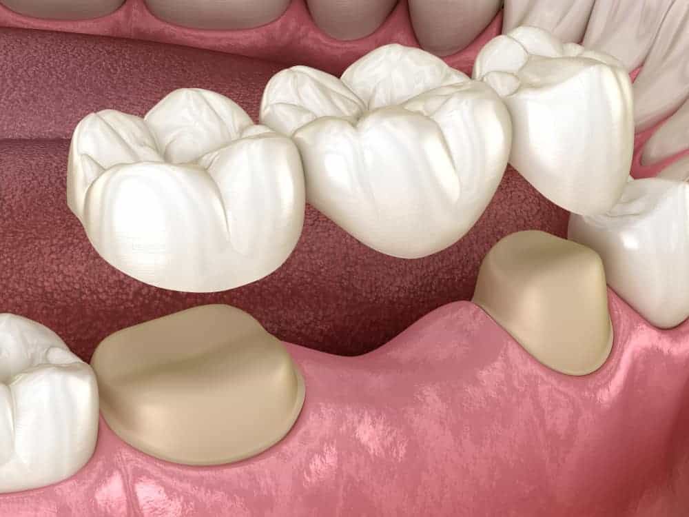 dental bridges in carrollwood