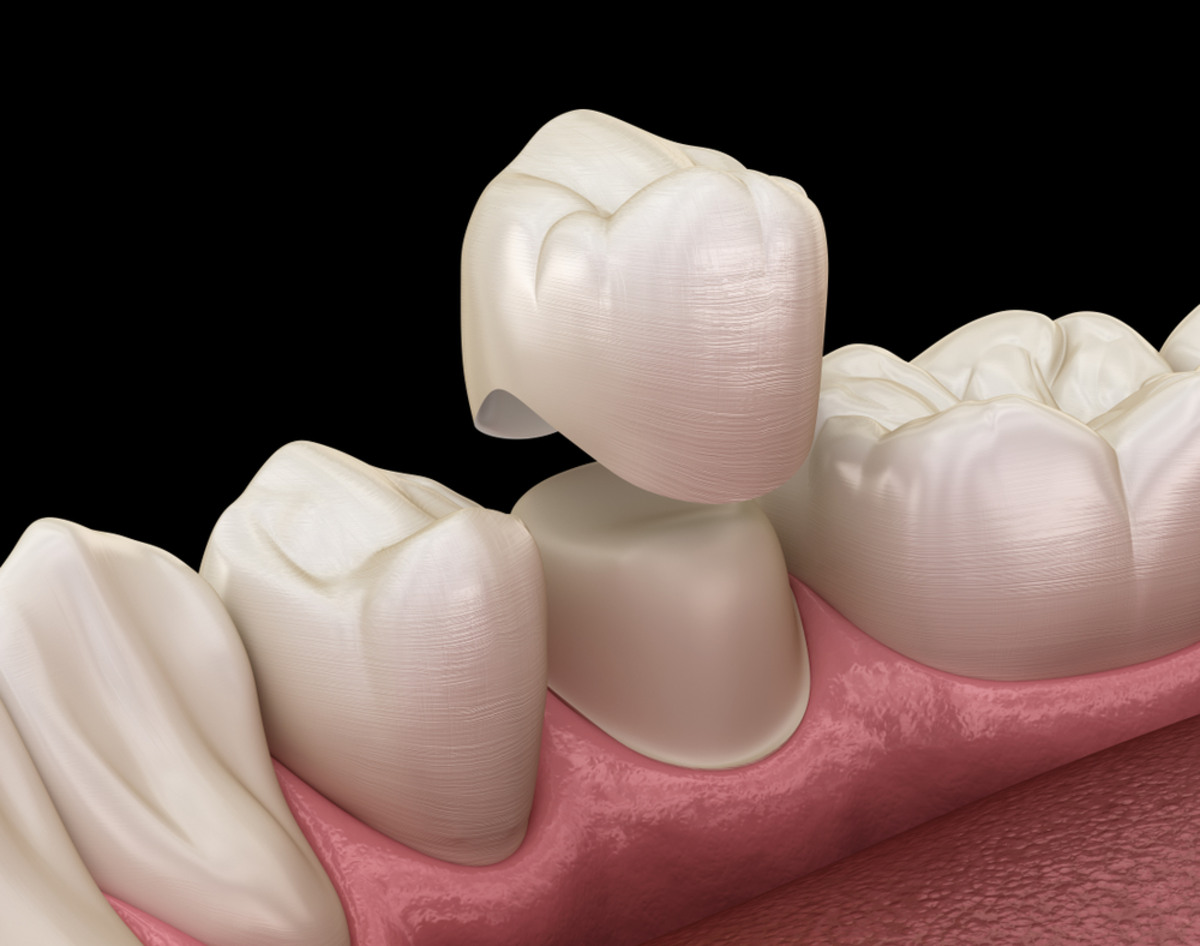 what are cerec crowns and how do they work