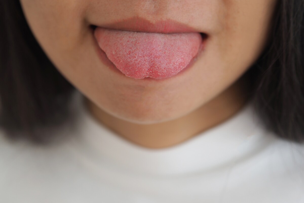 white tongue causes and treatment options