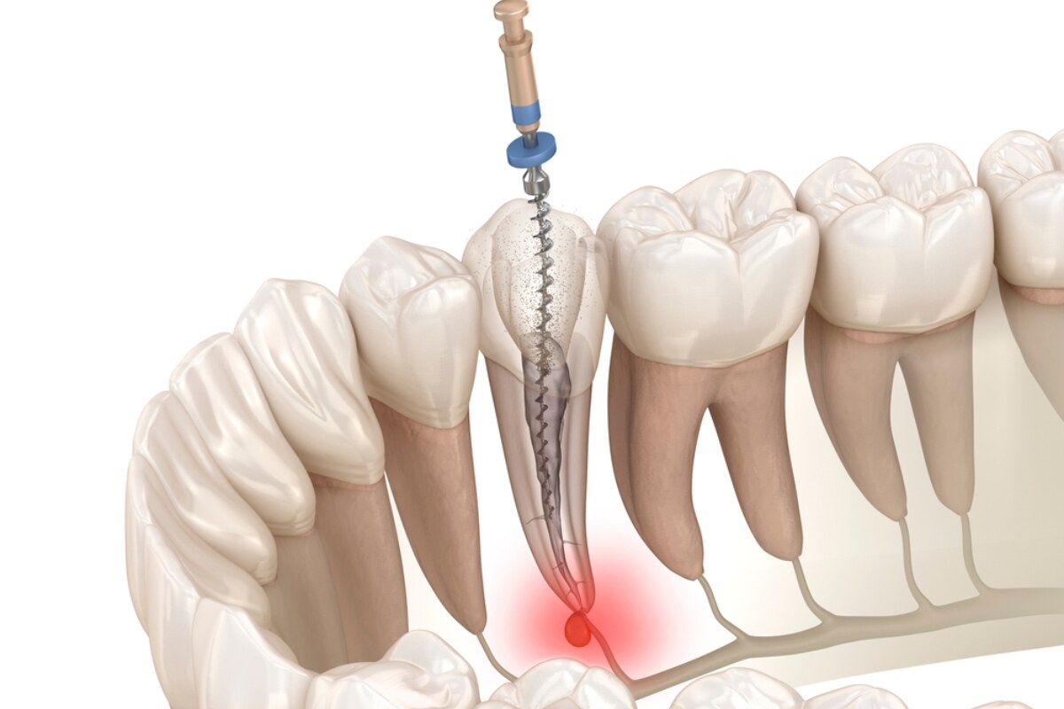 how root canal therapy saves your natural tooth